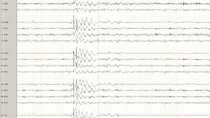A representative EEG of a patient with generalized Epilepsy.