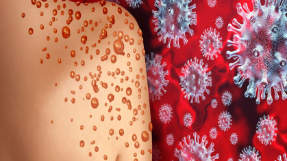 monkeypox virus illustration